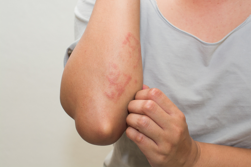 Woman with a skin rash on her arm
