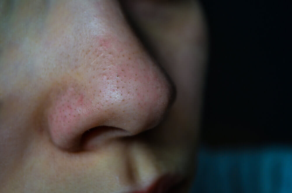 Young woman’s nose with blackheads on it